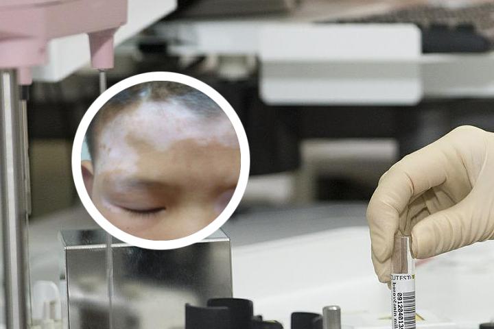 白癜风用什么可以遮盖呢