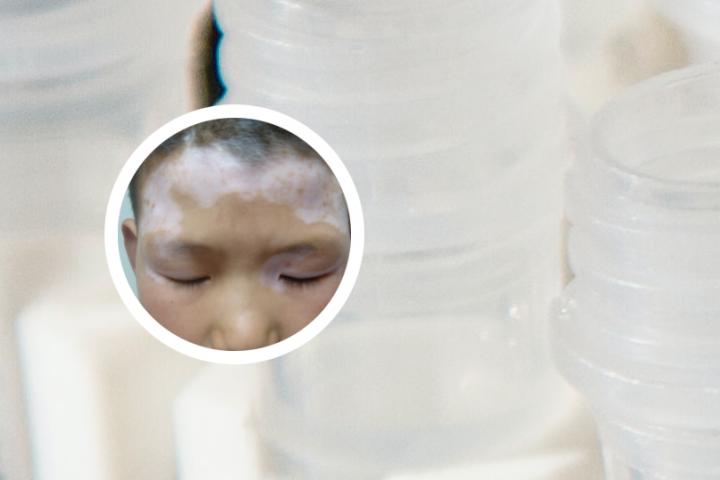 白癜风万能膏 白癜风自愈10大方法