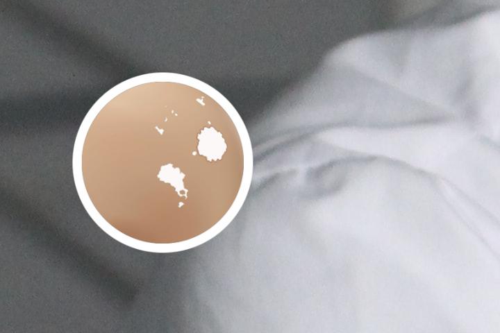 成都看白癜风博润优选