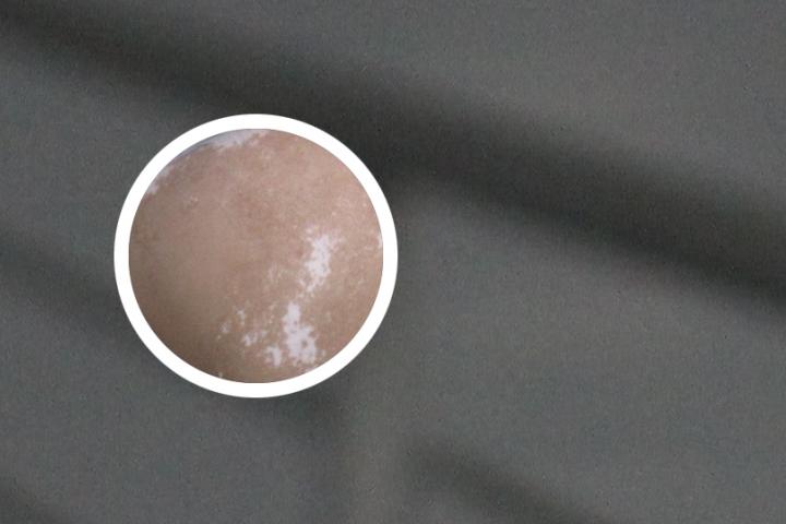 参紫汤治疗白癜风