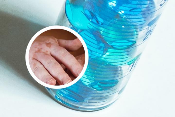 白癜风白斑消失