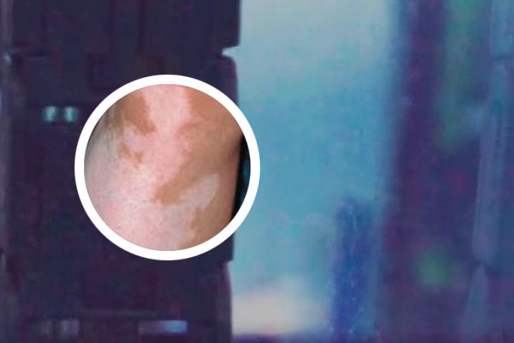 白癜风患者瓠子能吃吗
