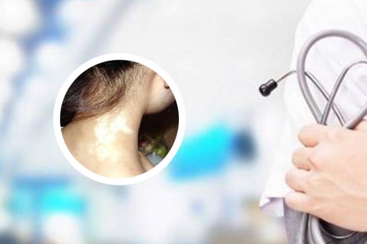 白癜风为什么治不好呢