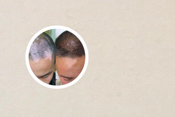 白癜风患者需要补什么