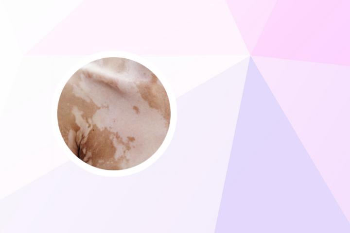 白癜风美妆博主