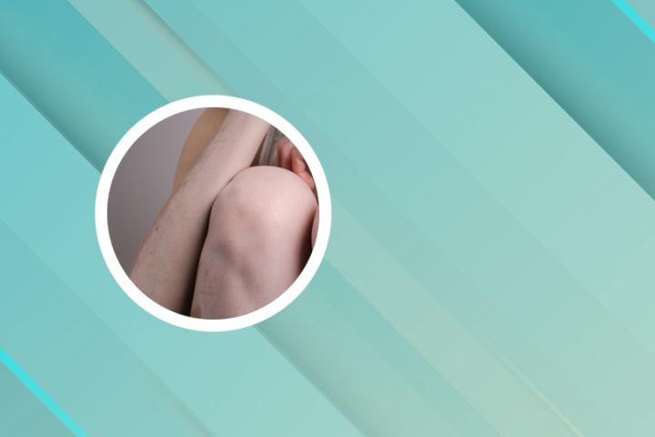 白癜风患处汗毛变黑