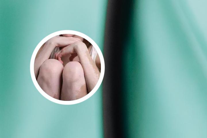 男人会介意女人是白癜风吗