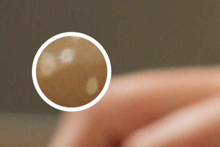 什么是白癜风的早期呢
