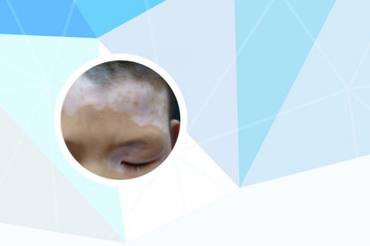 白癜风与汗斑癣
