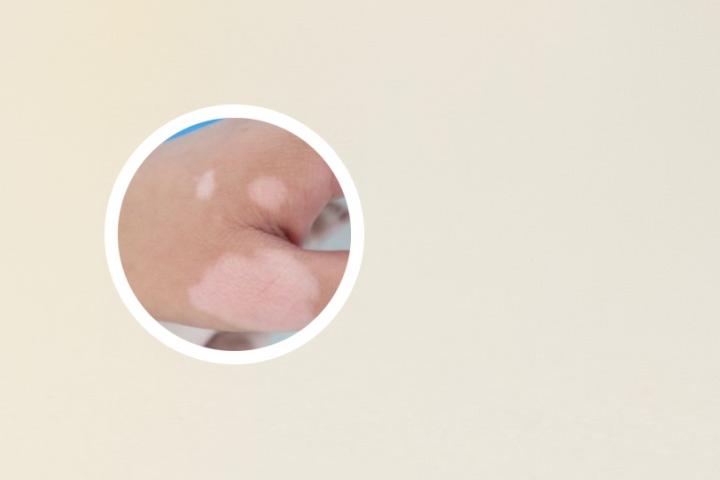 白癜风患者柿子能吃吗