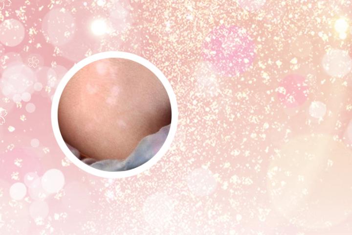 白癜风男女发病概率
