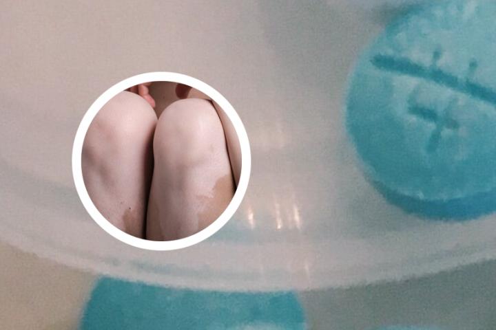 小孩得白癜风传染吗