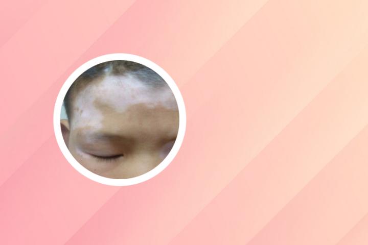 白癜风患者应该用什么洗
