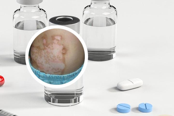 白癜风患者可以吃鲤鱼吗
