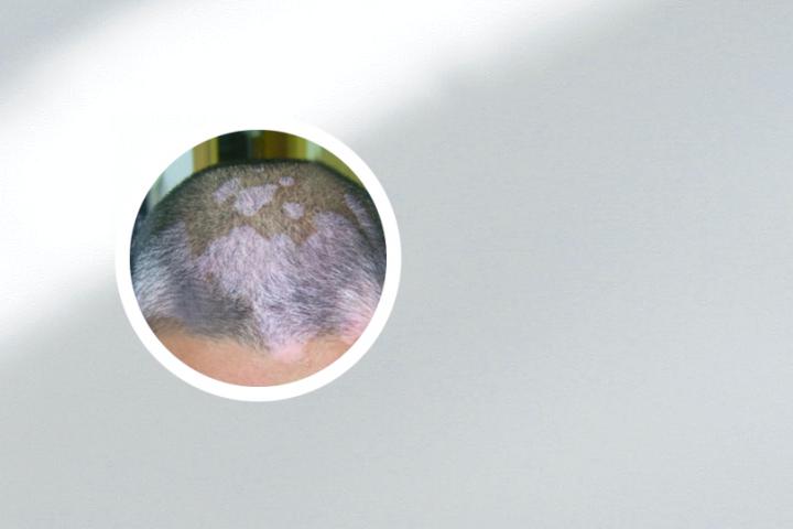 深圳治疗白癜风效果好