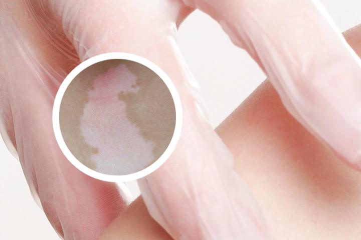 烟酒和白癜风恩怨
