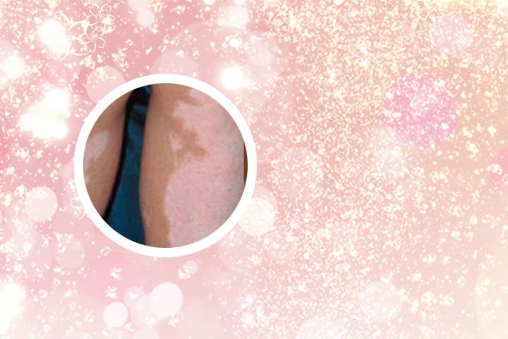 常吃什么水果可以治疗白癜风