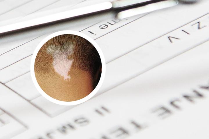 上海白癜风激光治疗价格