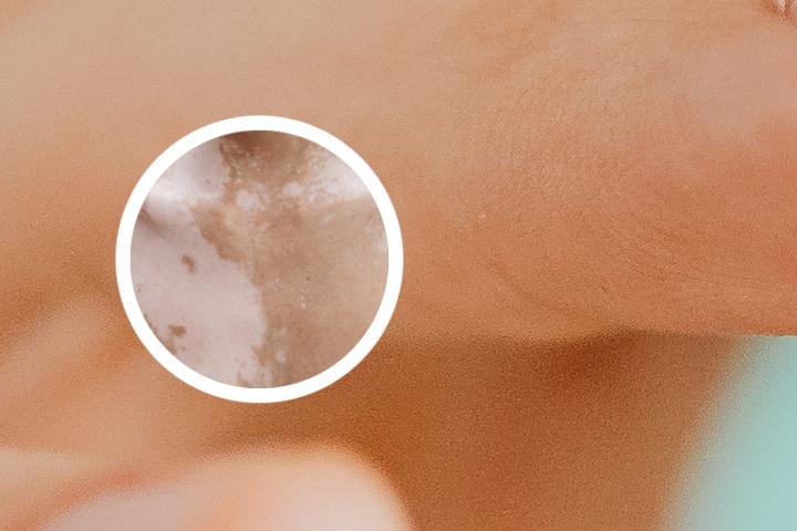 白癜风患者可以吃奶粉
