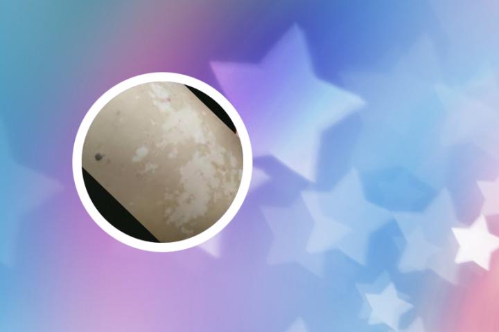 白癜风应该吃螺丝吗