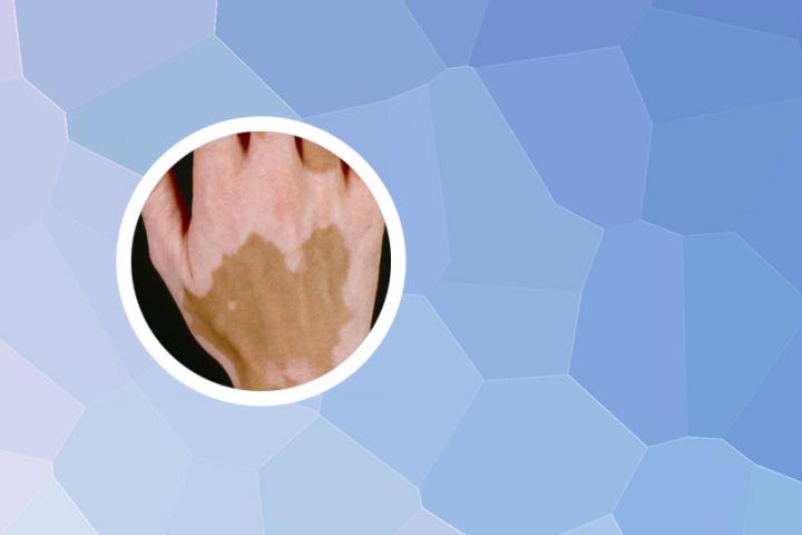 白癜风发病能自愈吗