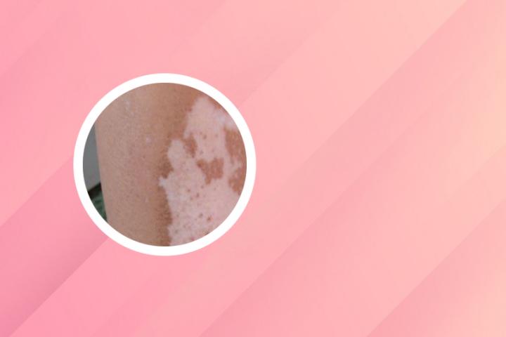 白癜风究竟怎么治