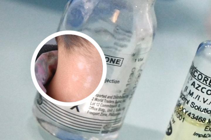白癜风怎么恢复黑色素