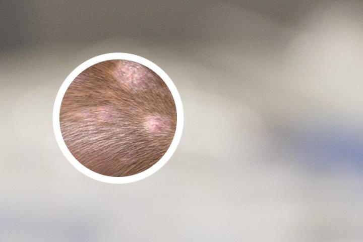 老公有白癜风怎么要孩子