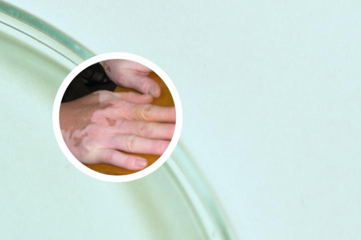 成都二医院可以查白癜风吗
