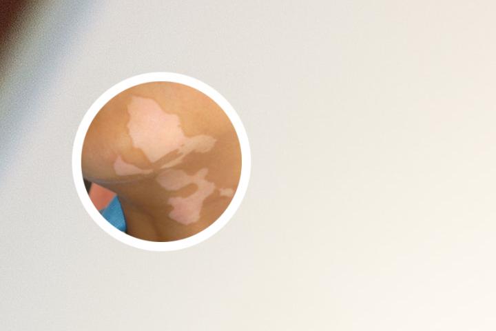 后期得的白癜风遗传么