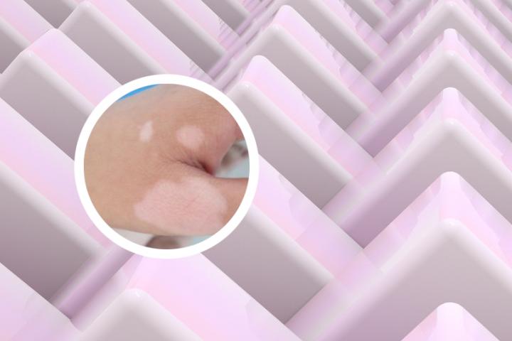 光疗治疗白癜风有用吗