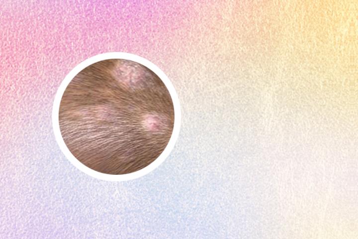 白癜风丸长期吃伤身体吗