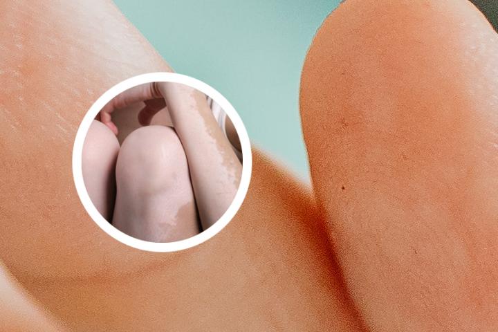 贴眼睫毛容易得白癜风吗