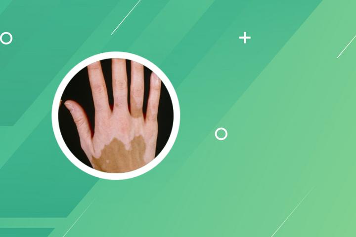 沙苑子颗粒能治疗白癜风吗