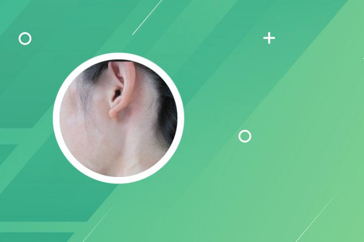 白癜风激光后刺激性红斑