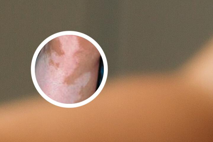 南召白癜风治疗