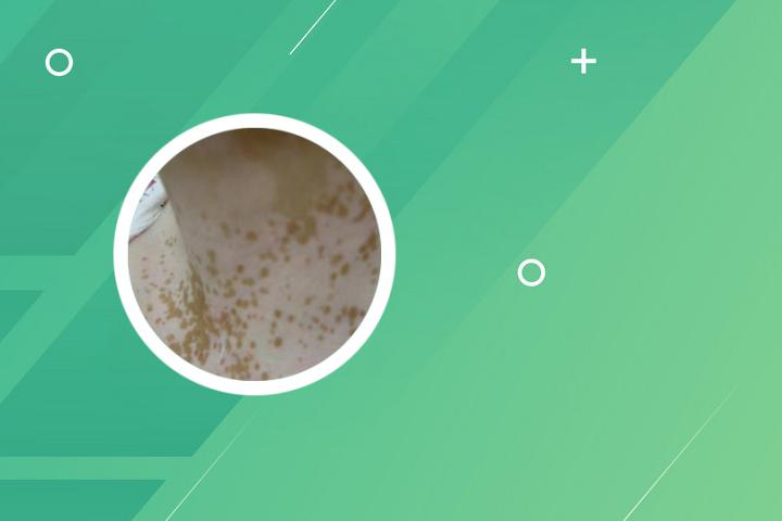 白癜风危害的图片 白癜风危害有什么