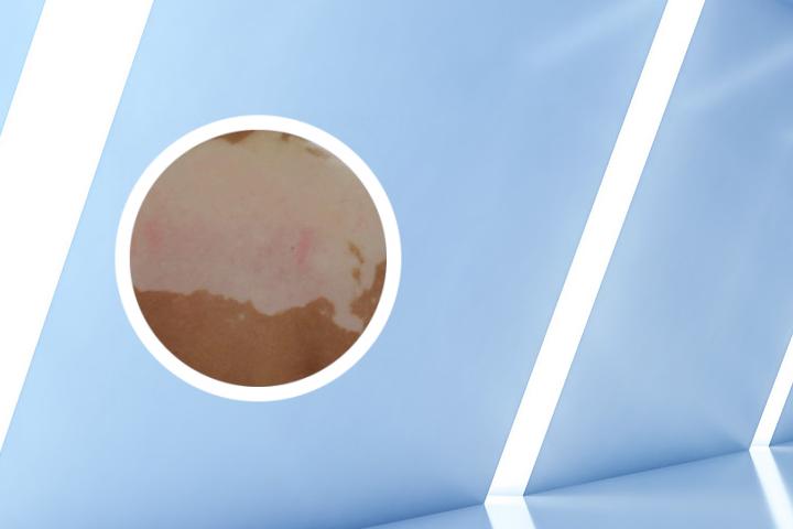白癜风要多吃些什么