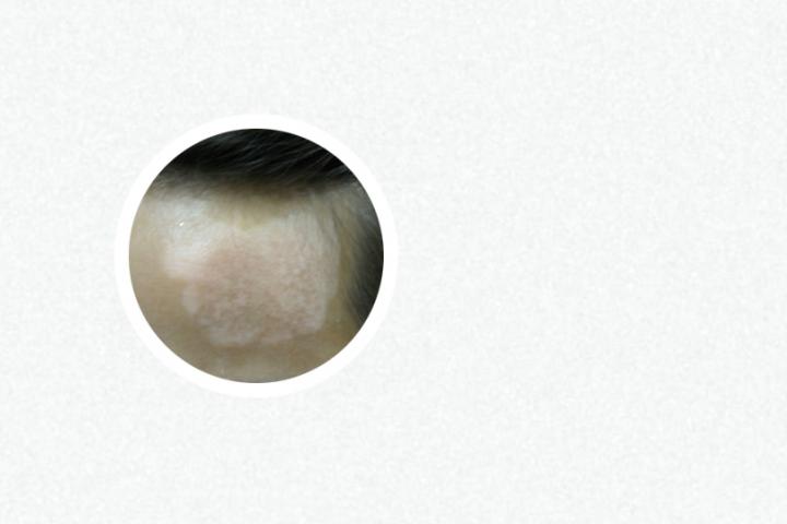 白癜风注射黑色素