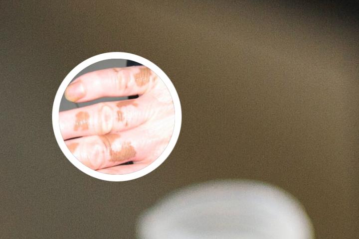 白癜风光疗过后起泡怎办