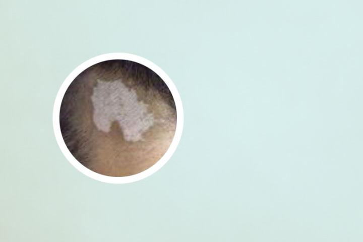 白癜风完全康复的概率