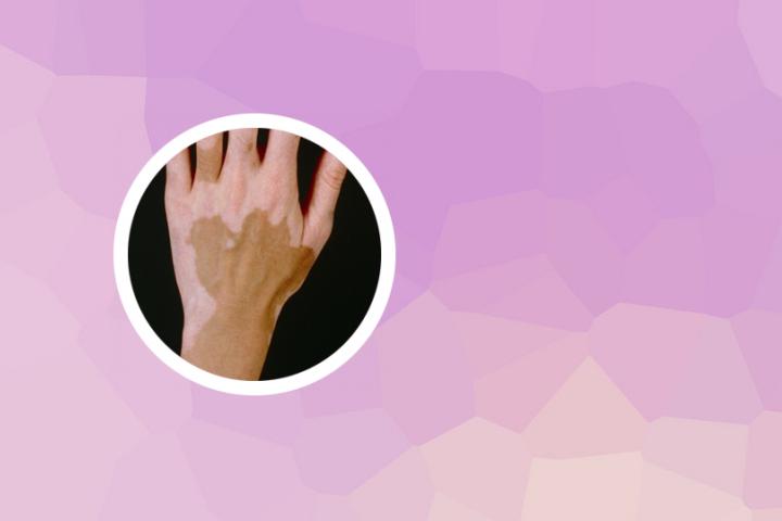 中年白癜风患者该如何护理
