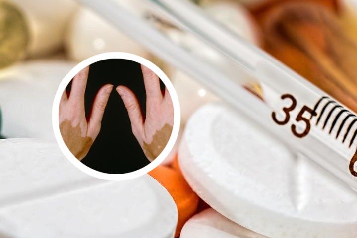 合肥哪家医院白癜风看得好