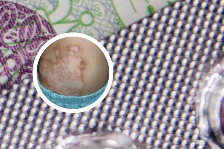 11岁白癜风能治好吗