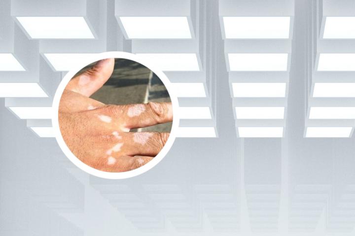 白癜风危害表现 白癜风危害身体么