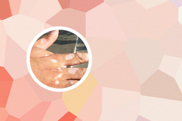 白癜风微微泛红 白癜风微量元素缺乏能治好吗