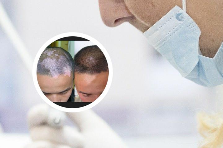 白癜风形成位置