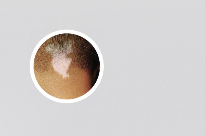 辽阳哪家看白癜风好点