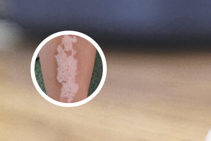 冯小刚白癜风自愈的方法