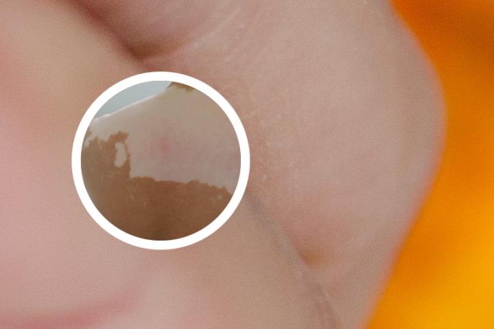 怎么治疗白癜风